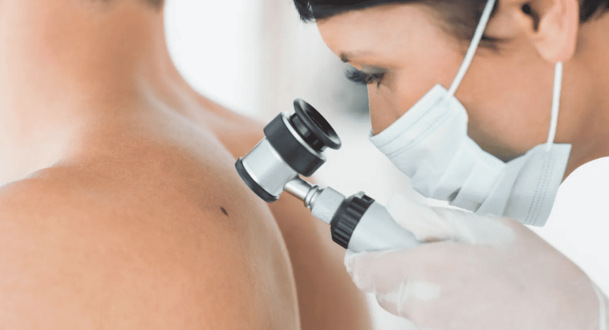 Día Mundial del Cáncer de Piel: conocé la regla ABCDE para detectar señales de alerta. Día Mundial del Cáncer de Piel: conocé la regla ABCDE para detectar señales de alerta.